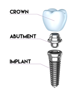 imagine Can't read or write Loaded Dental Implants Oconomowoc - Summit Dental Excellence