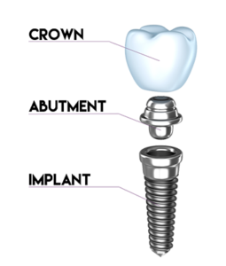 Dental Implant Illustration