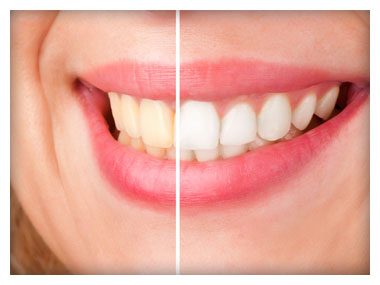 Teeth Whitening Before/After