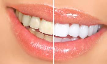 Teeth Whitening Before & After