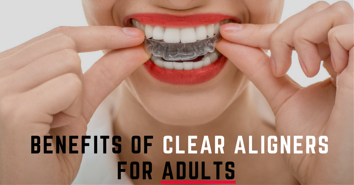 Benefits of Clear Aligners for Adults