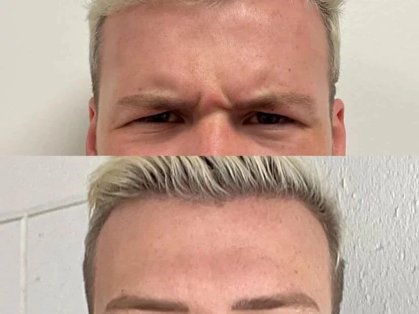 Oconomowoc-Wrinkle-Relaxers-after-before